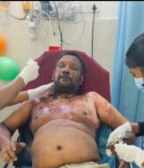 जेएमएम नेता पर तीन लोगों को पेट्रोल डालकर जलाने का आरोप, पुलिस जाँच में जुटी